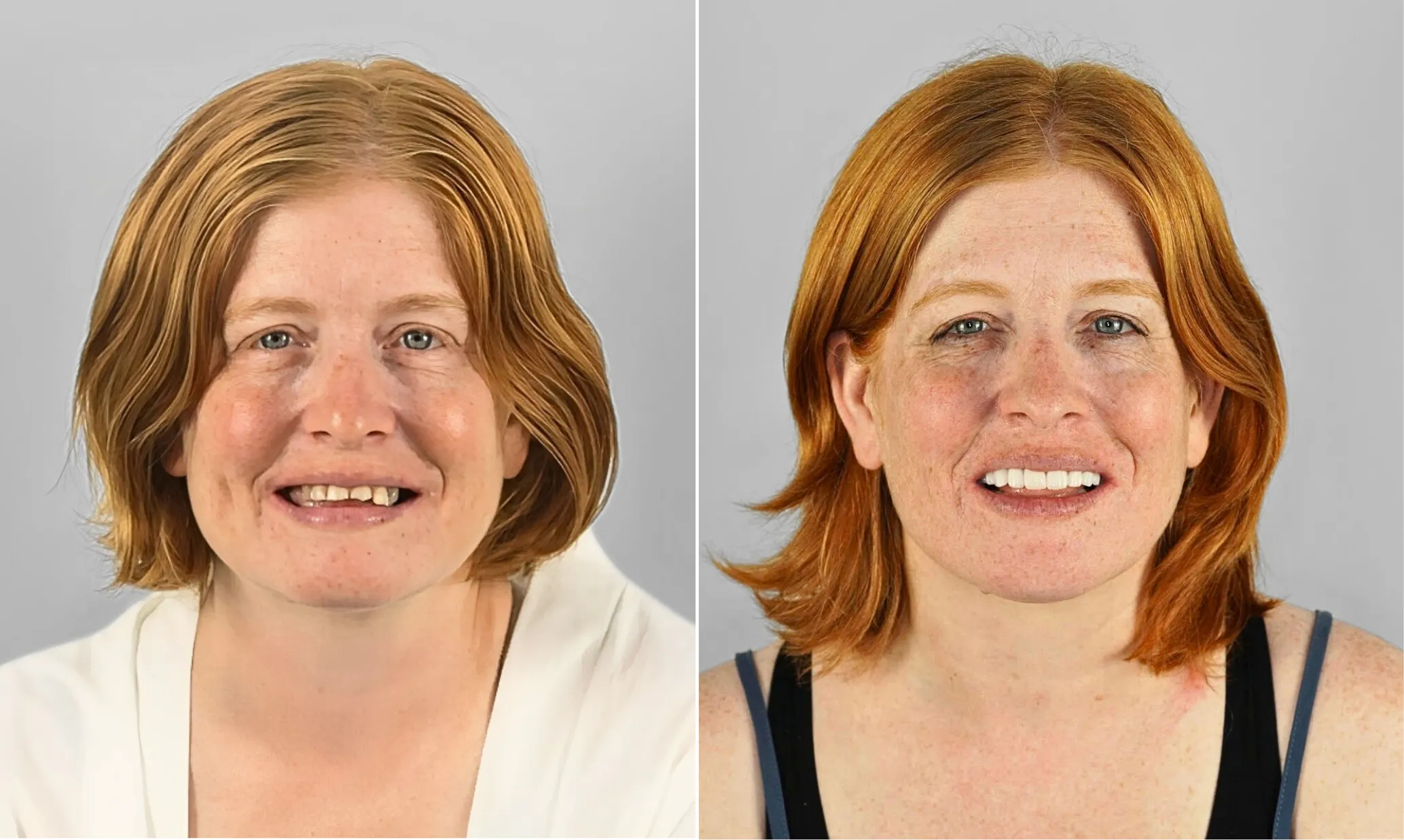 Before and after dental implants — female patient