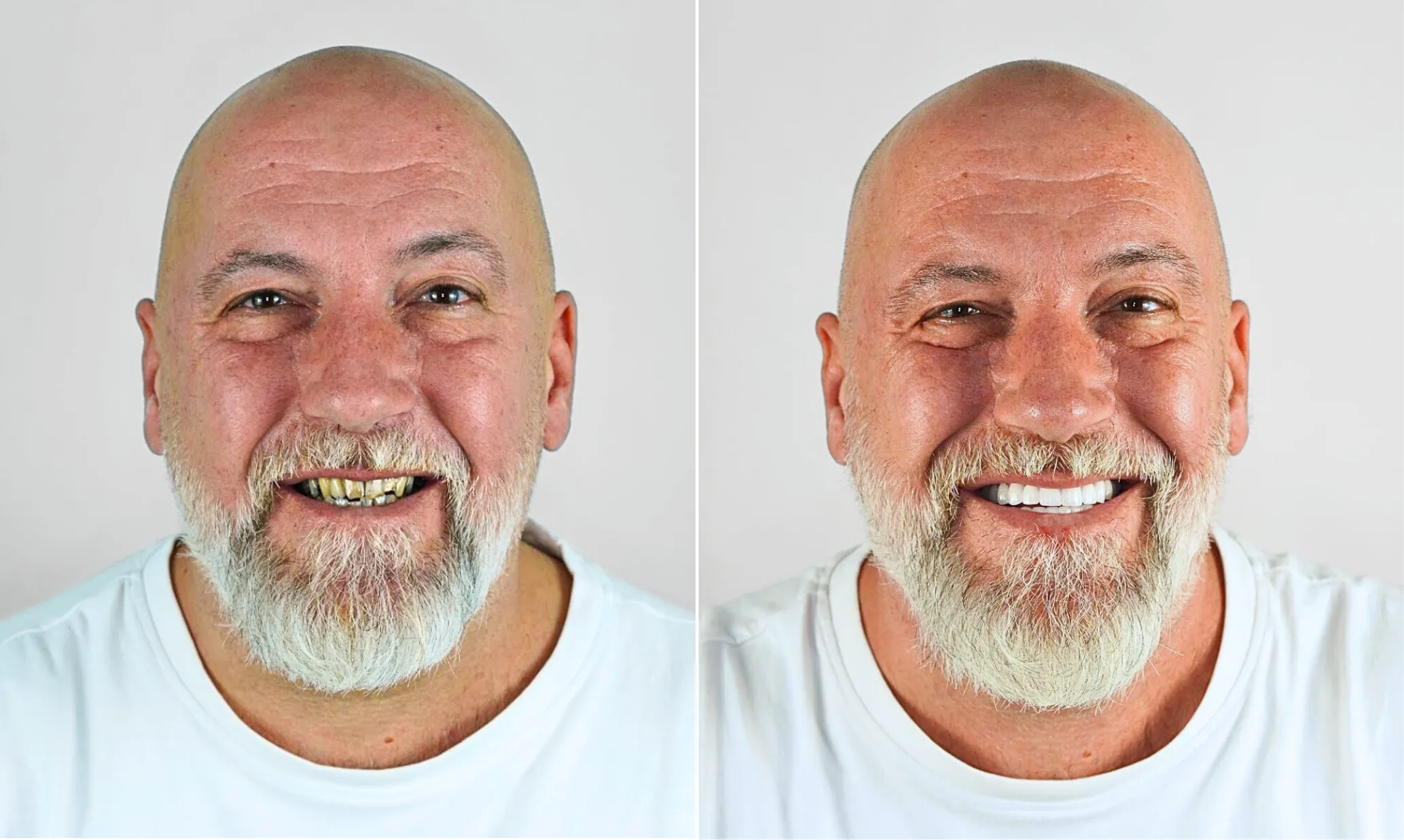 Before and after dental implants — male patient