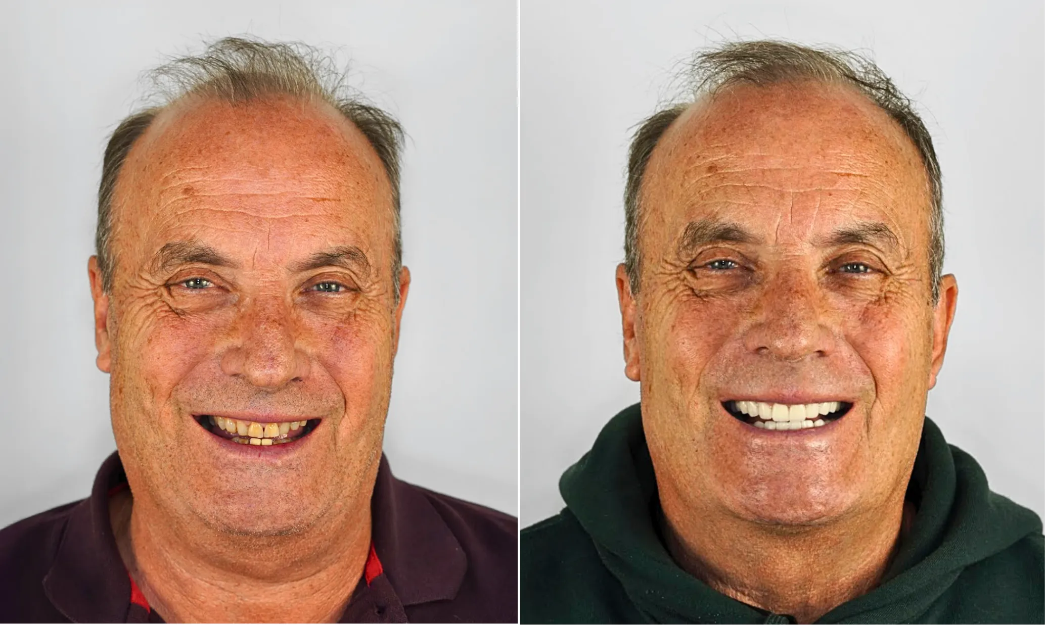 Before and after dental implants — male patient