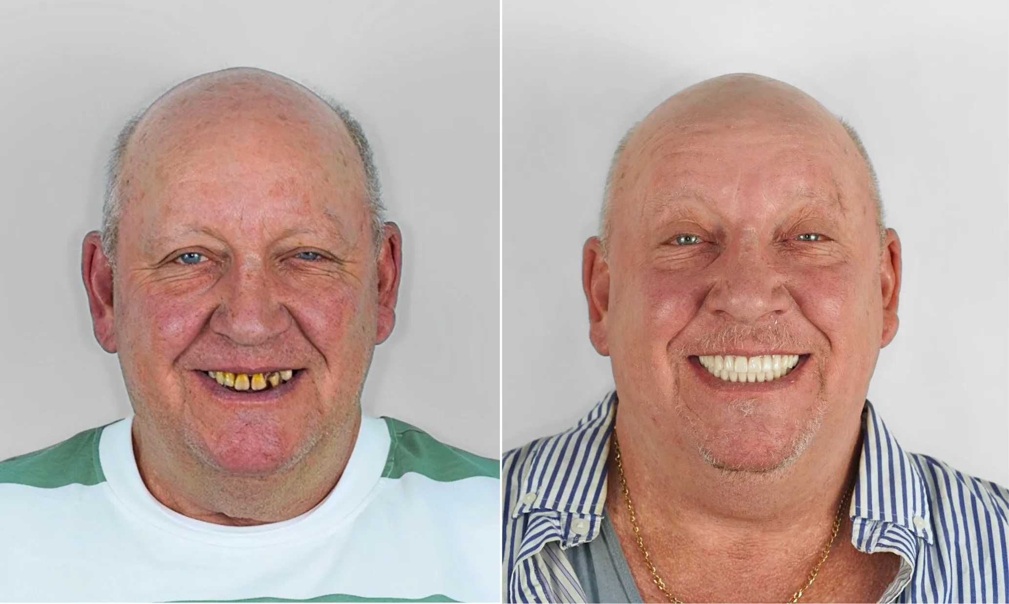 Before and after dental implants — male patient
