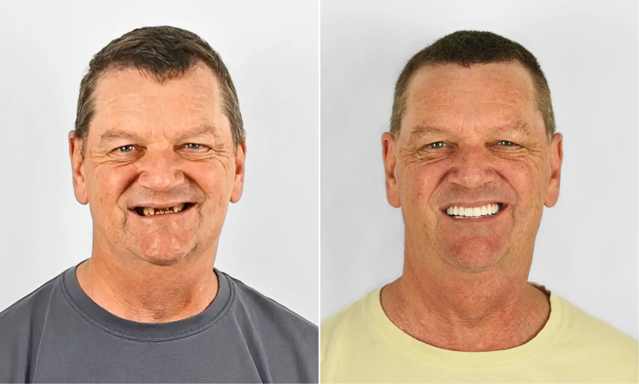 Before and after dental implants — male patient