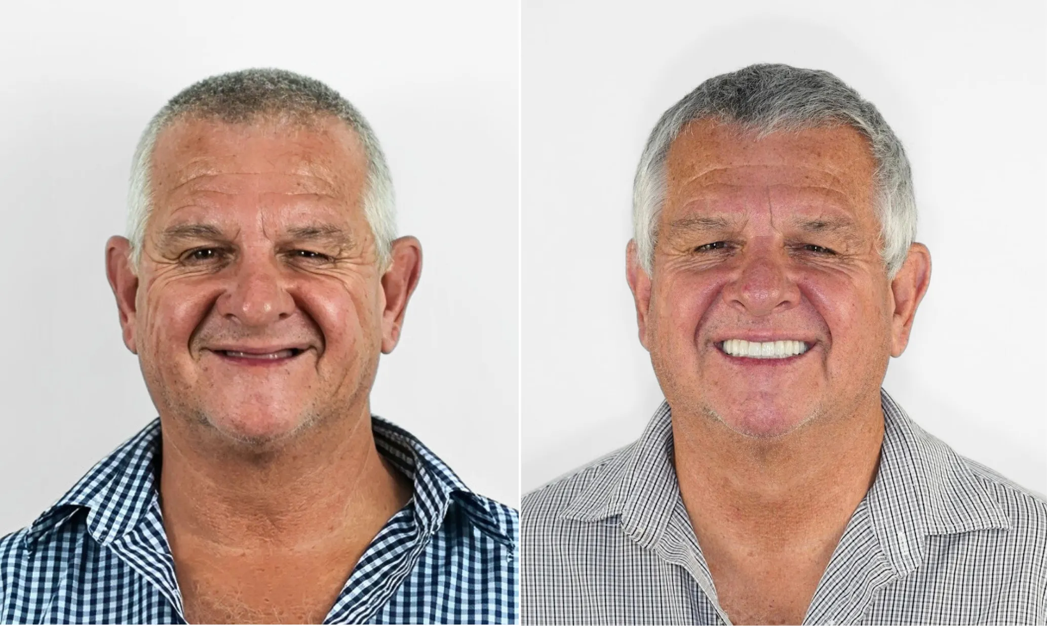 Before and after dental implants — male patient