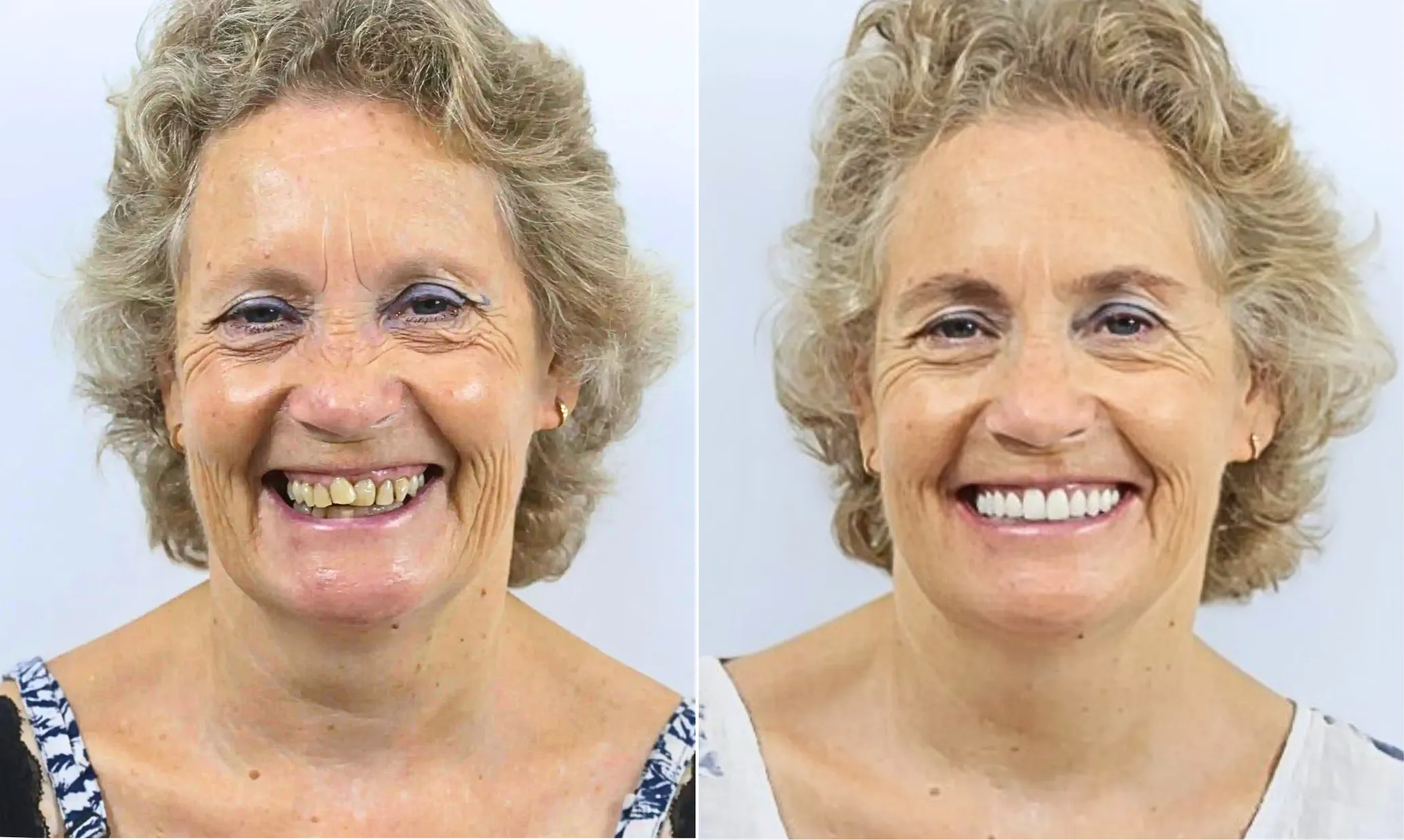Before and after dental implants — female patient