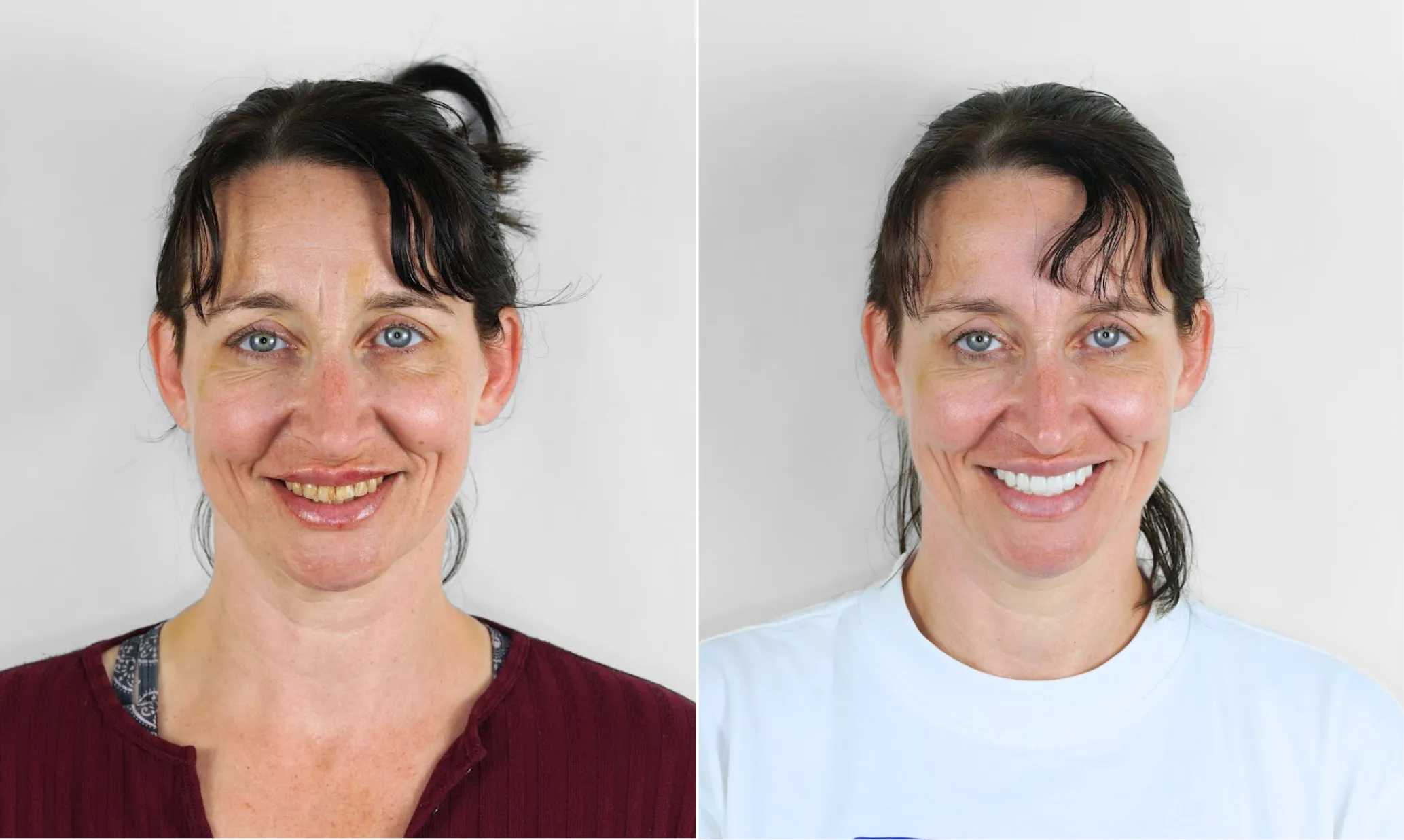 Before and after dental implants — female patient