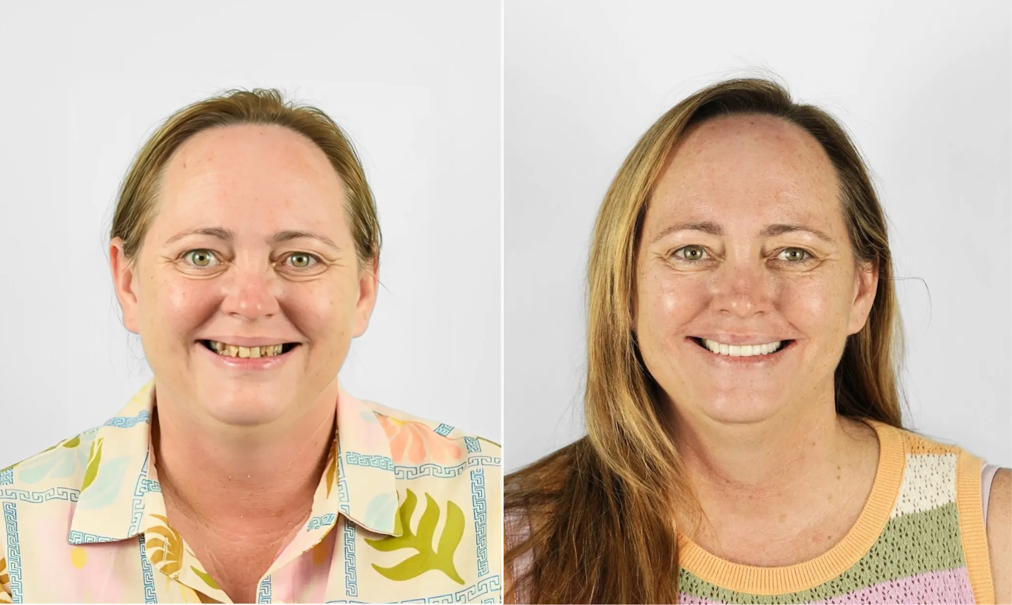 Before and after dental implants — female patient